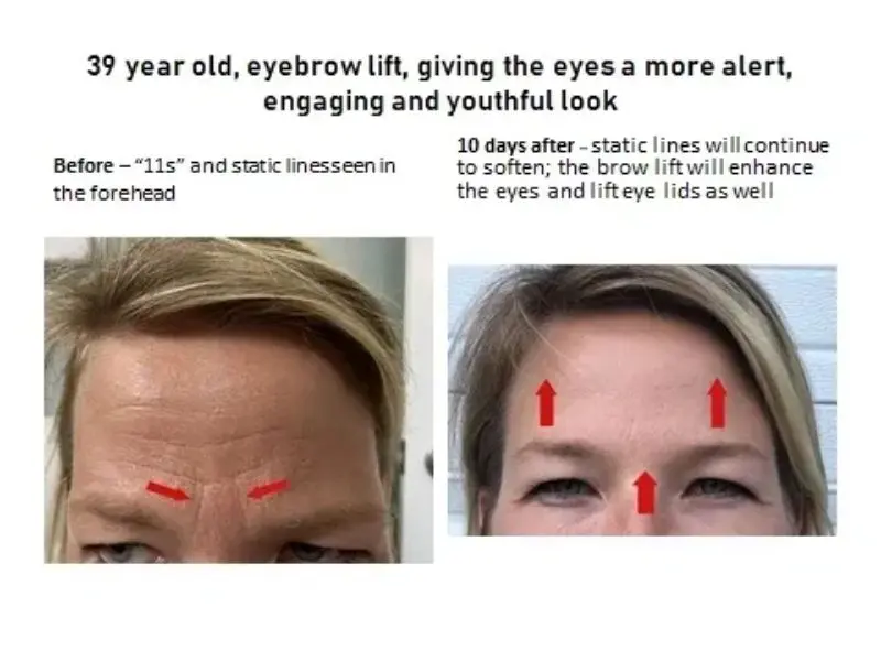 Eyebrow Lift, Using Xeomin Injection HD Aesthetics in Newtown, PA