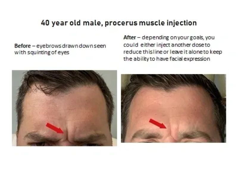 Before After Procerus Muscle Injection With Xeomin HD Aesthetics Newtown, PA