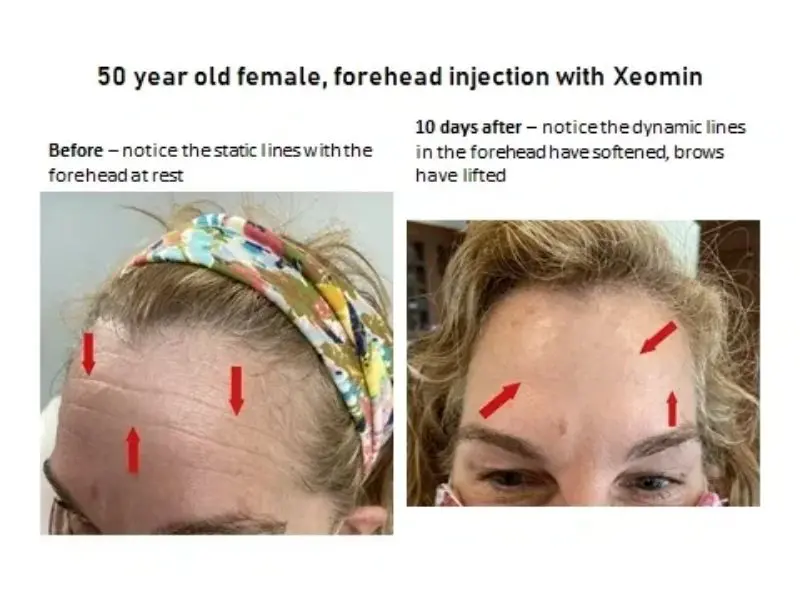 Forehead Injection with XEOMIN for Forehead Lift HD Aesthetics in Newtown, PA