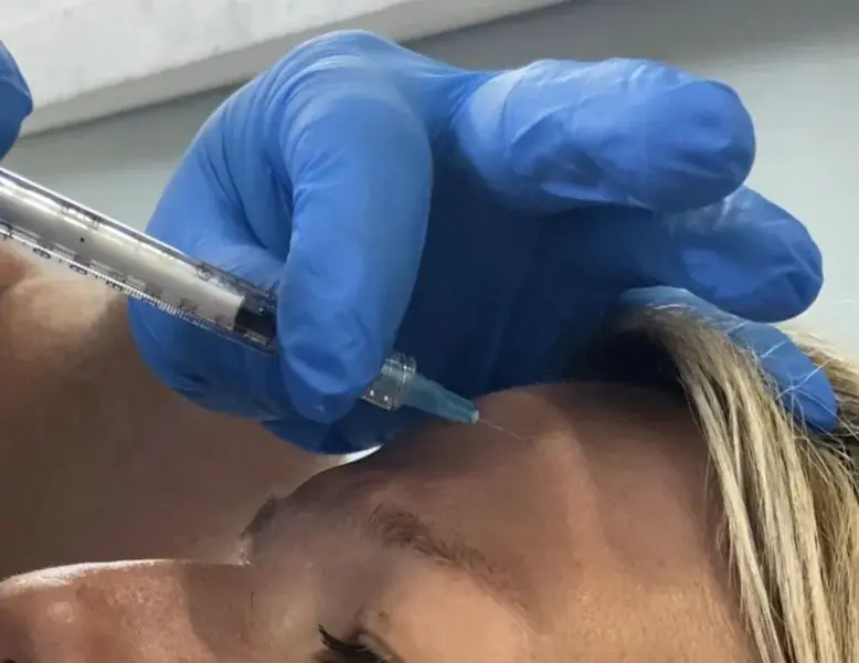 Forehead Injection Using Xeomin