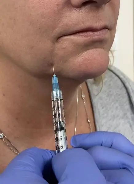 Lip Contouring in Injecting the Depressor Agnuli Oris With Xeomin