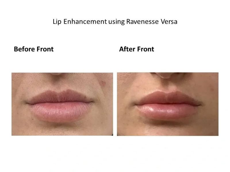Lip Filler Enhancement Using Revanesse Versa Dermal Filler