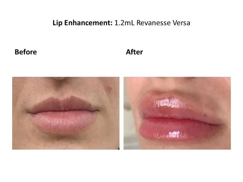 Lip Filler Enhancement Using Revanesse Versa Dermal Filler