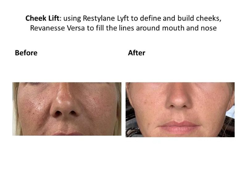 Cheek Lift Using Restylane Lyft, Revanesse Verse to Fill Lines Dermal FillerAround Nose and Mouth