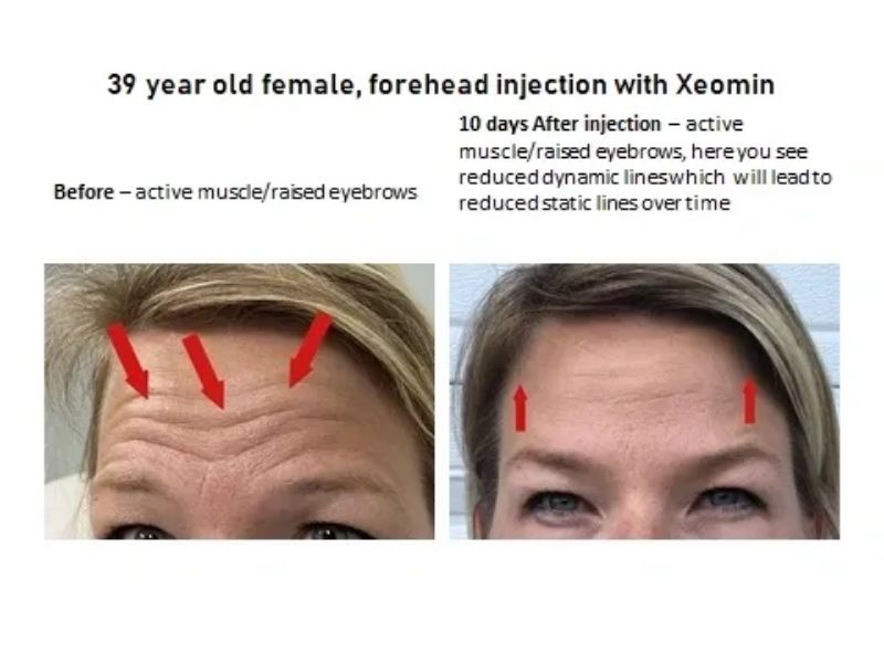 Before/after Injections Using Xeomin - Forehead Lines