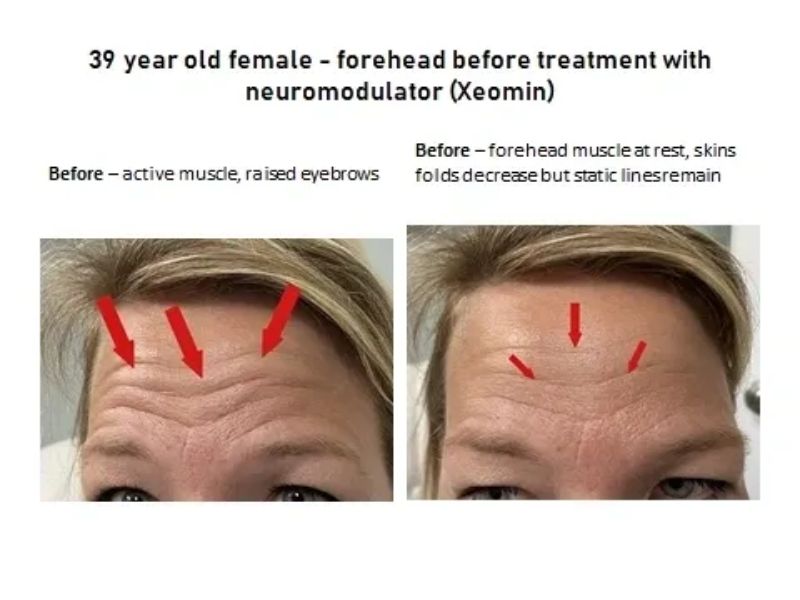 Before Xeomin Injection - Forehead Lines