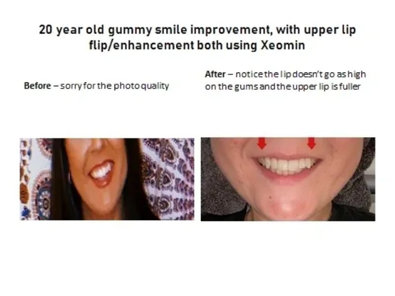 Gummy Smile - Before/after Xeomin Injection HD Aesthetics in Newtown, PA