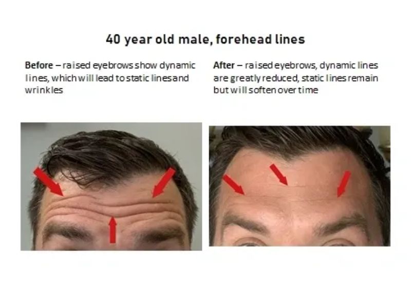 Forehead Lines - Before/after Xeomin Injections HD Aesthetics in Newtown, PA